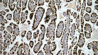 Immunohistochemical stain for p63 in Epithelial-Myoepithelial Carcinoma of Salivary Gland, CUMC Pathology and Cell Biology