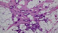 Tubular Breast Carcinoma, CUMC Pathology and Cell Biology